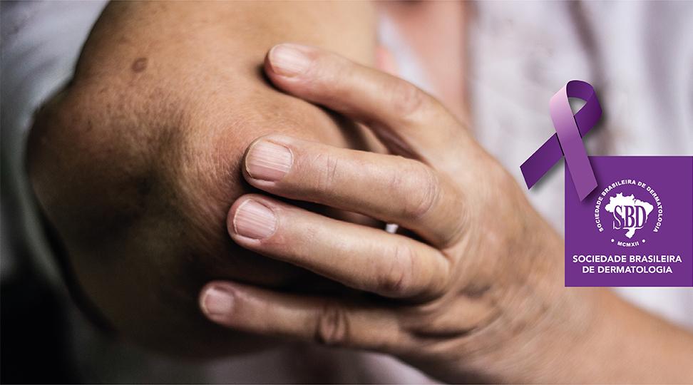Hanseníase: as causas, sintomas e tratamentos da doença de pele